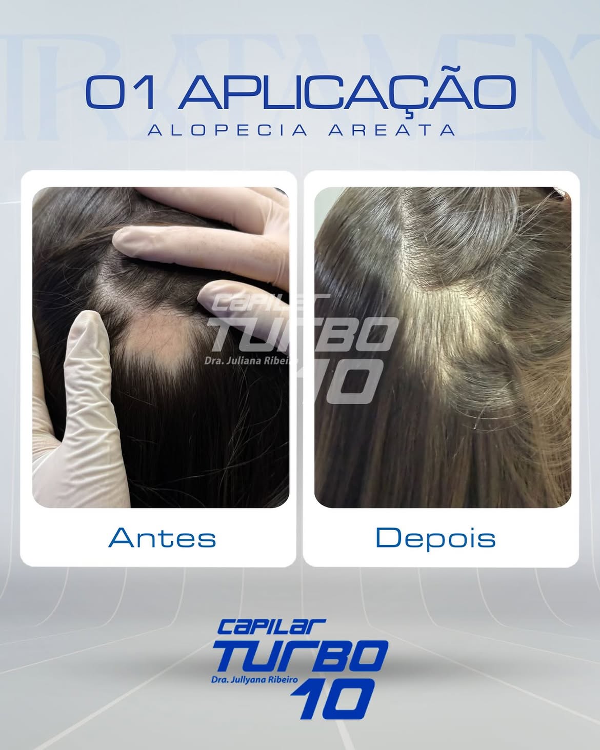 01 aplicação, alopecia areata