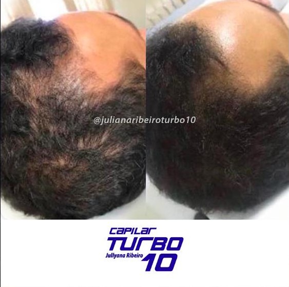 Antes e depois, coroa masculina, densificação capilar